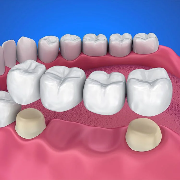 Dental Crowns and Bridges