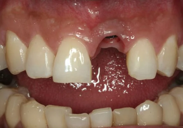Dental implant treatment before