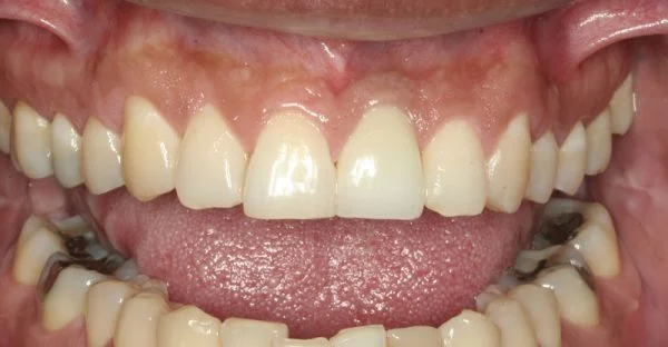 Dental implant treatment after