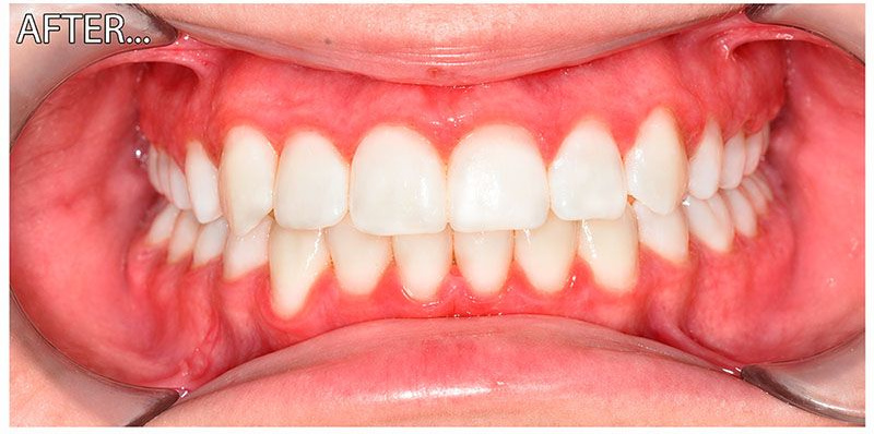 Braces and aligners treatment after