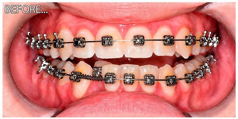 Braces and aligners treatment before