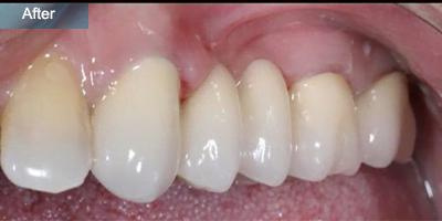 Crowns and bridges treatment after