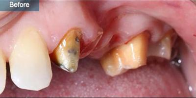 Crowns and bridges treatment before