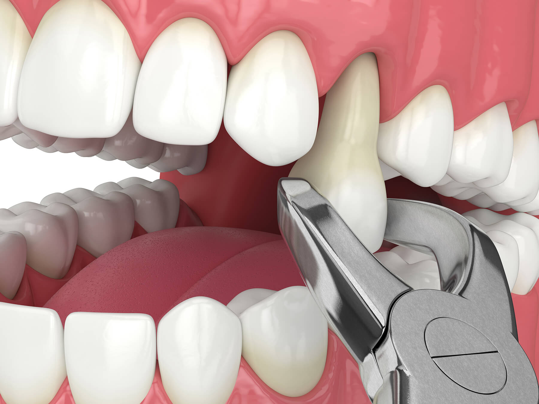 Professional Tooth Extraction