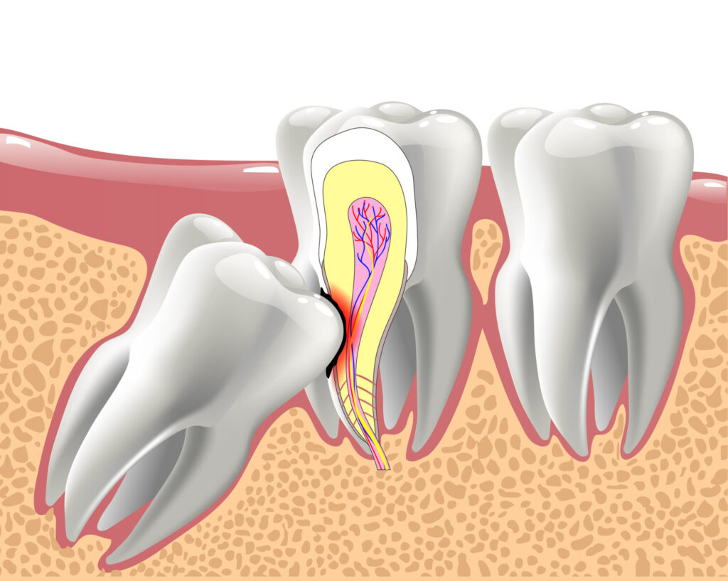 Impacted Tooth Treatment